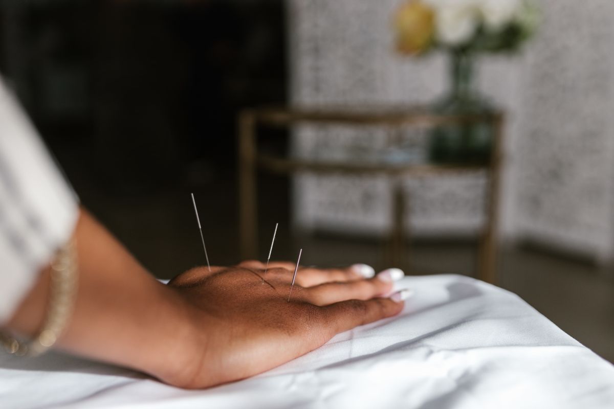 Acupuncture needles being applied to a patient's hand
