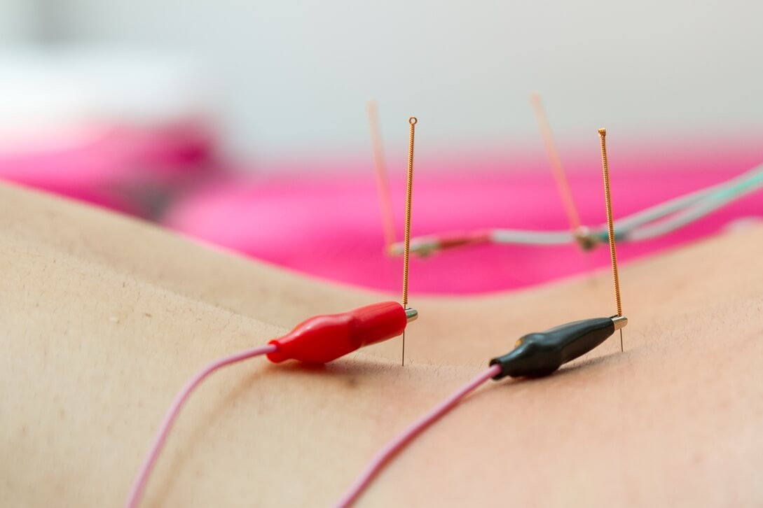 Electro-acupuncture treatment